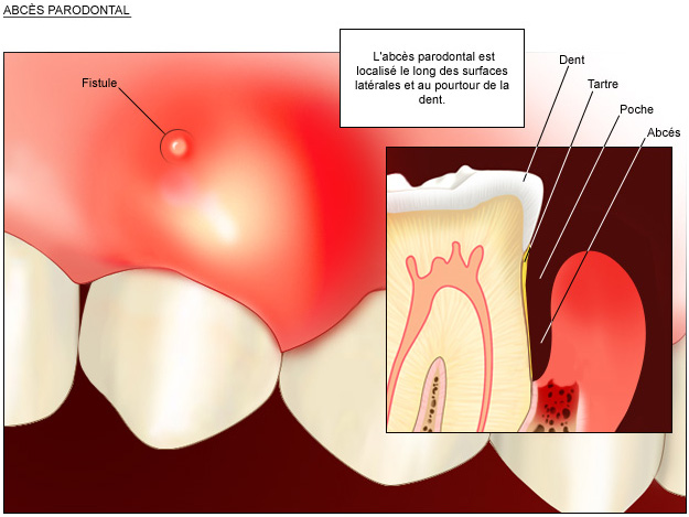 abces-parodontal