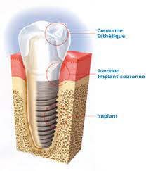 implants2